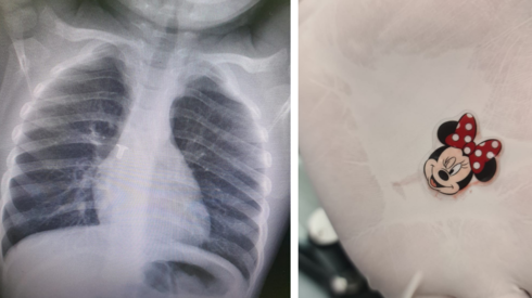 גופים זרים שבלעו ילדים