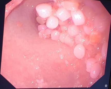 עשרות כדורי ג'לי מתנפחים הוצאו מקיבתו של פעוט